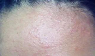 额头长痘痘了怎么办